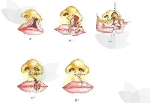 唇裂.jpg